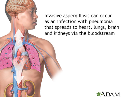 Pulmonary aspergillosis