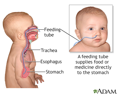 Feeding tube