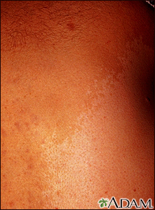 Neurofibromatosis - large cafe-au-lait spot