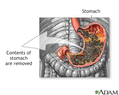 Gastric suction