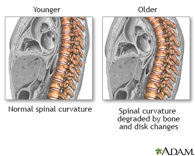 Changes in spine with age