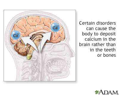 Cranial calcification